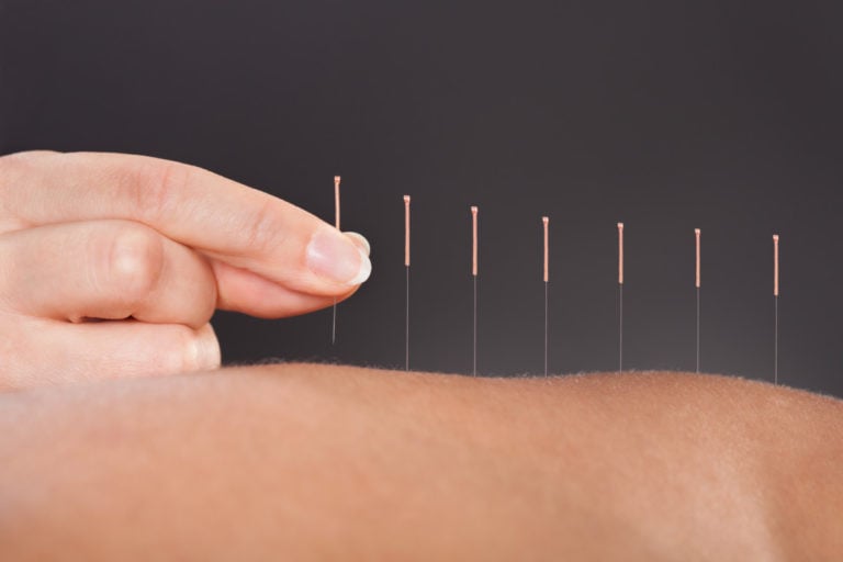 Acupunctuur is een belangrijk onderdeel van de Traditionele Chinese Geneeskunde